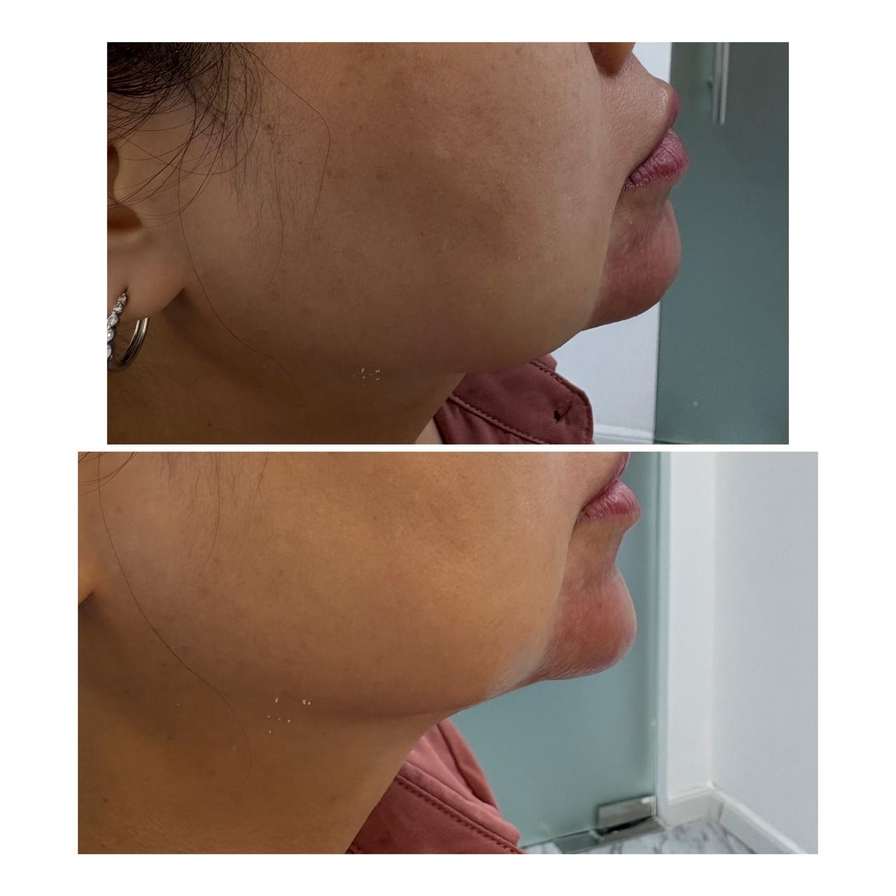 Chin Contouring — before and after