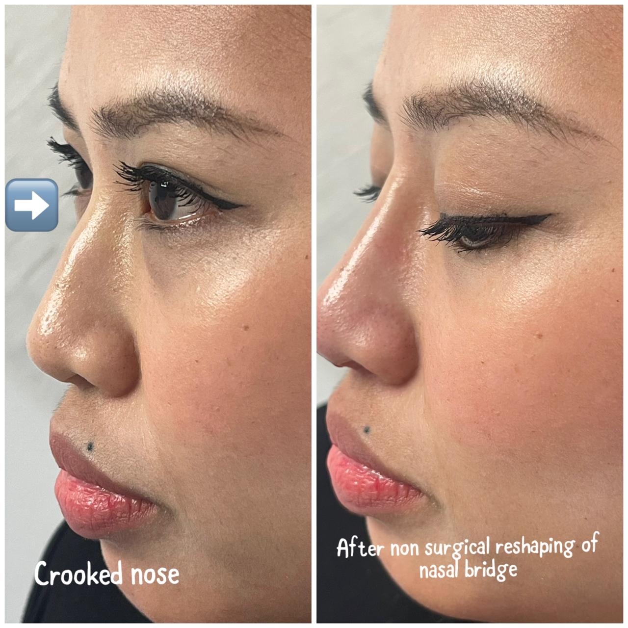 Thread Lifting — before and after