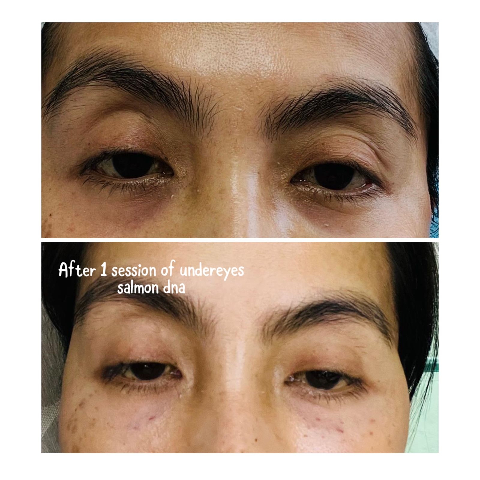 Under-Eye Rejuvenation — before and after